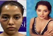 Raiza wilson demands rs 1 crore from dermatologist for wrong treatment
